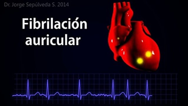 ARRITMIAS CARDÍACAS - TODO LO QUE DEBES SABER