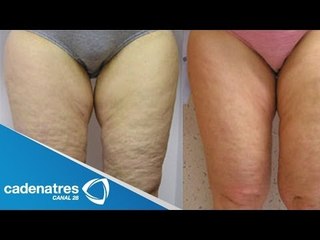 ¿Cómo quitar la celulitis?  /  ¡AÚN PUEDES ELIMINAR LA CELULITIS!  / How to remove cellulite?
