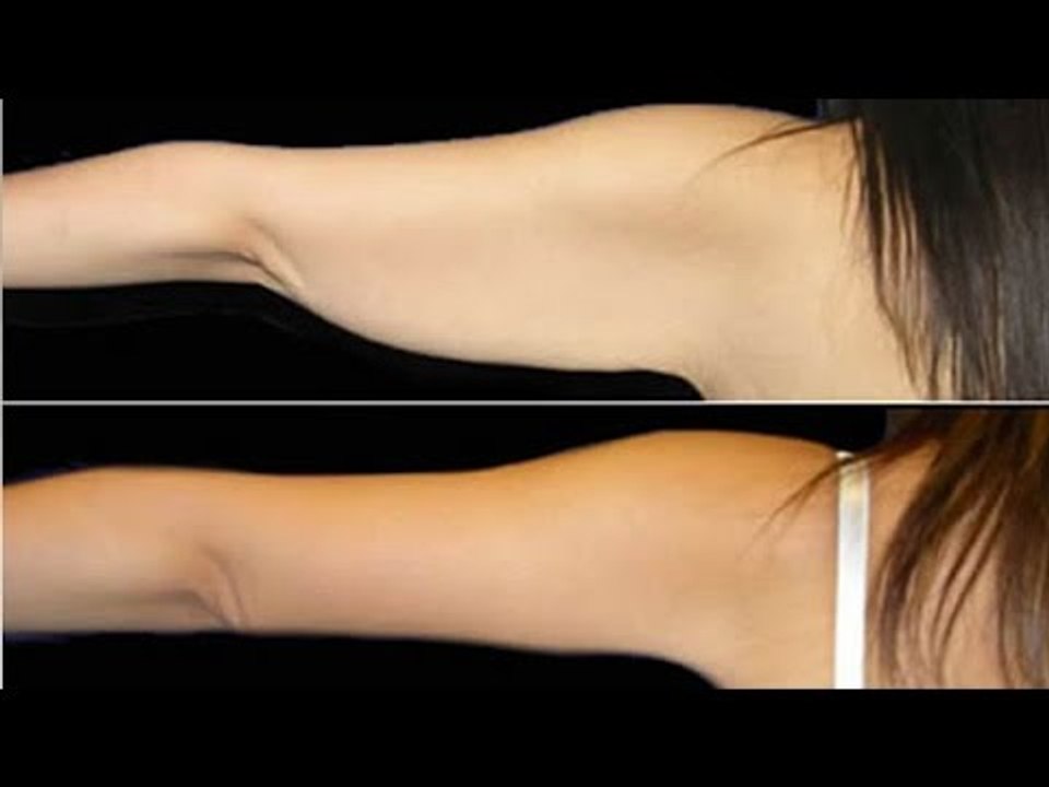 Elimina los gorditos de los brazos en 20 días / Elimina los gorditos