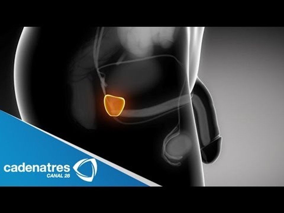 ¿Cómo prevenir cáncer de próstata? / How to prevent prostate cancer?