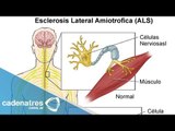 Neurólogos explican qué es la esclerosis lateral amiotrófica