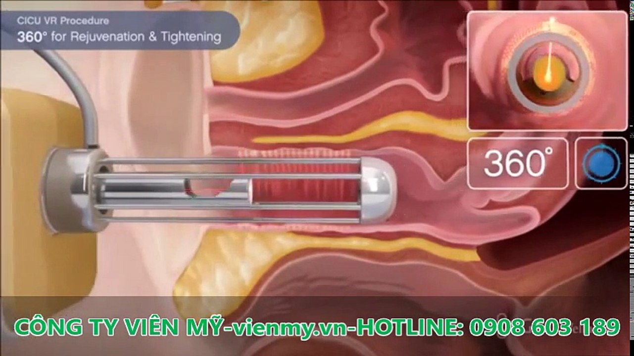Máy Fractional CO2 Laser Cicu-F - Công ty Viên Mỹ giới thiệu