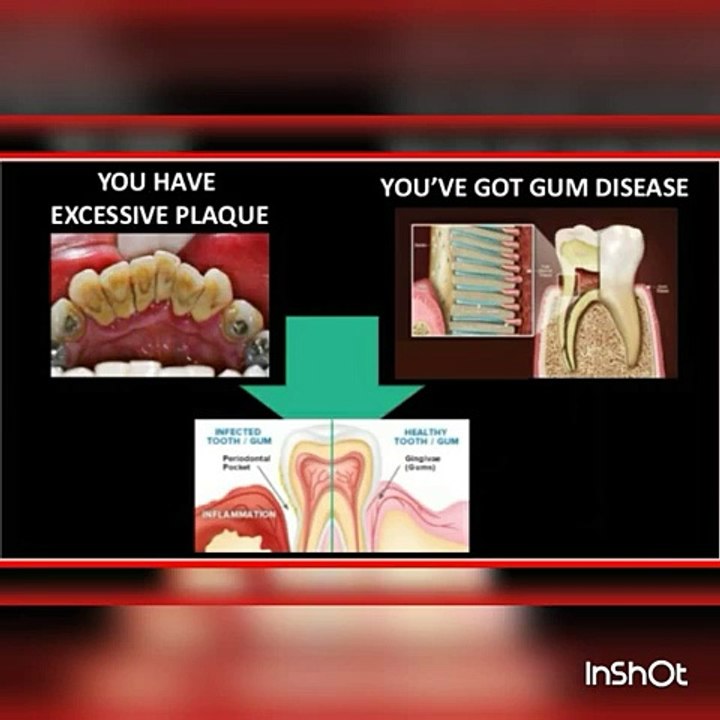 How to Keep Teeth & Gums Healthy   Home remedies for tooth decay and cavities