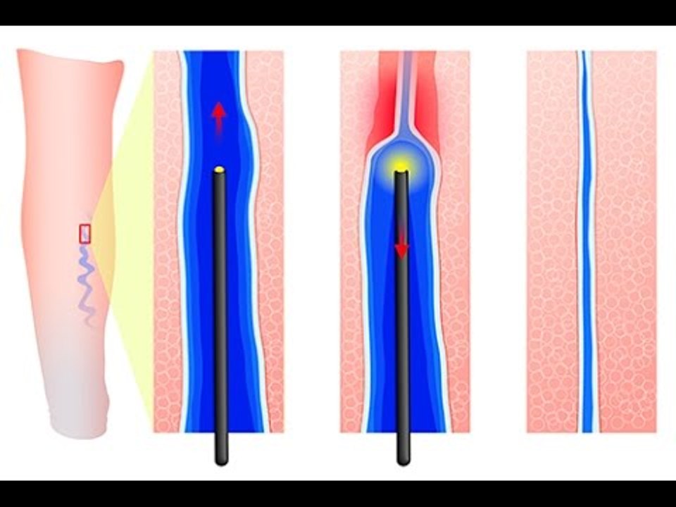Comment se soignent les varices ?