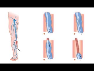 Les varices sont-elles dangereuses pour la santé ?