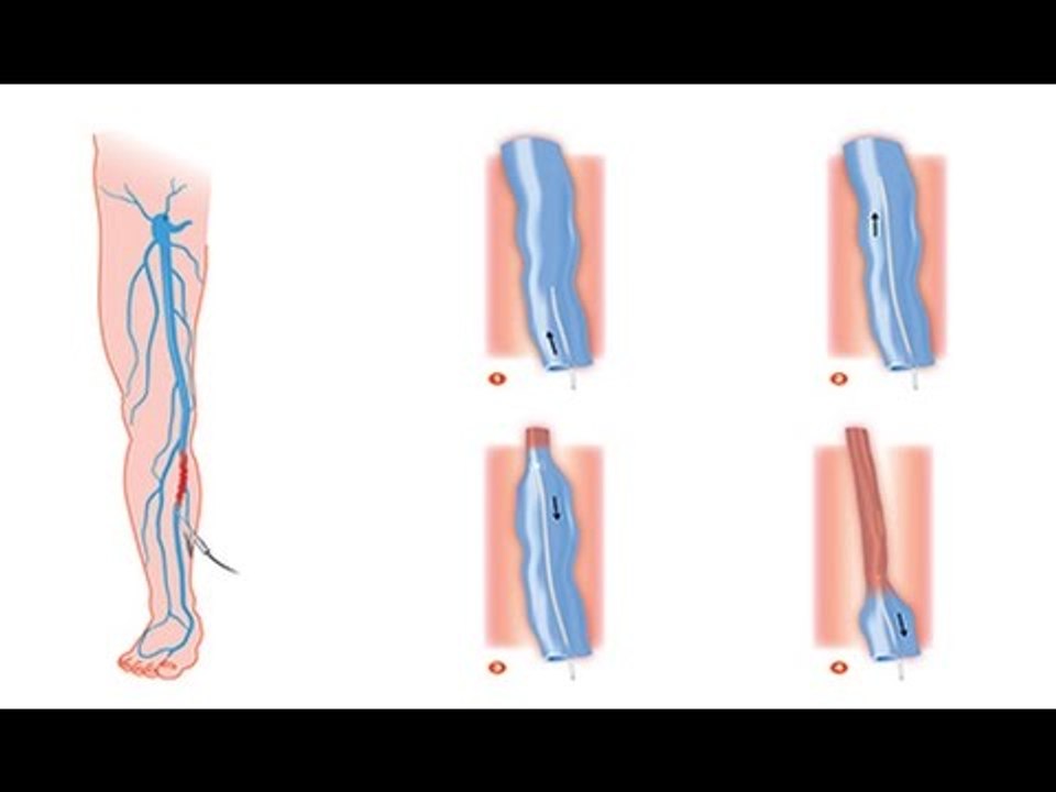Les varices sont-elles dangereuses pour la santé ?