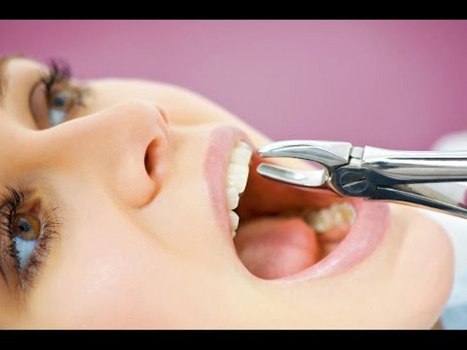 ¿Por qué extraer las muelas del juicio?