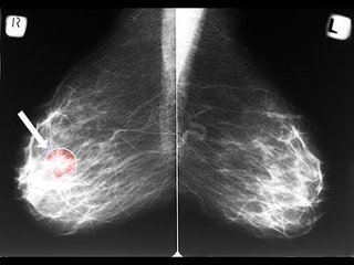 La mammographie après 50 ans est-elle indispensable  ?