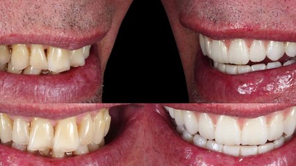 Full Mouth Reconstruction - Los Algodones, Baja California, Mexico
