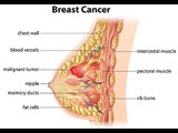 Quels sont les différents types de cancer du sein ?