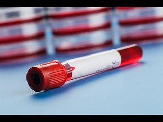 L'hypothyroïdie : que montrent les analyses du sang ?