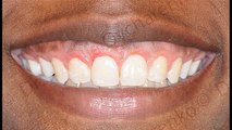 West Frisco Dental And Implants - Frisco TX Dentist - Dental Implants Frisco TX