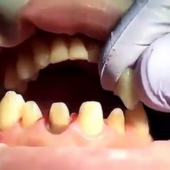 Cận Cảnh Cách Bọc Răng Sứ