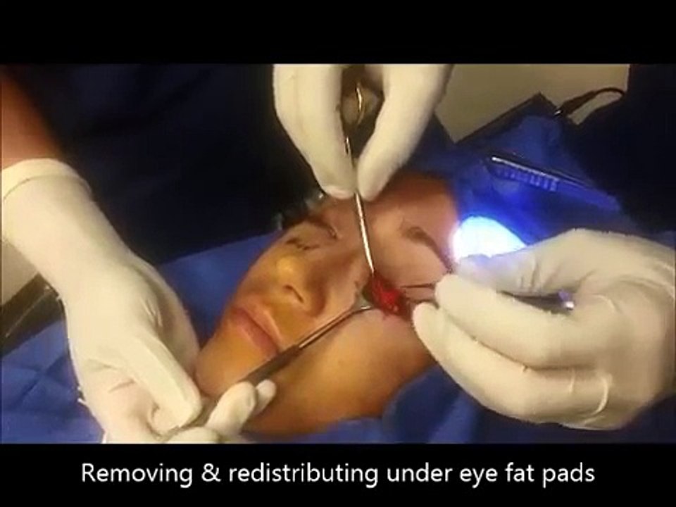 Lower Blepharoplasty By Dr. Taban MD