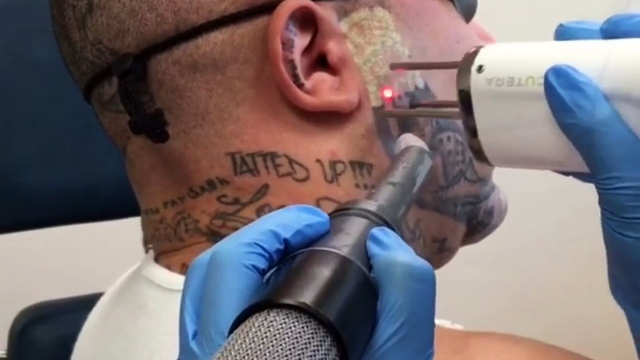 Tattoo Removal All You Need To Know