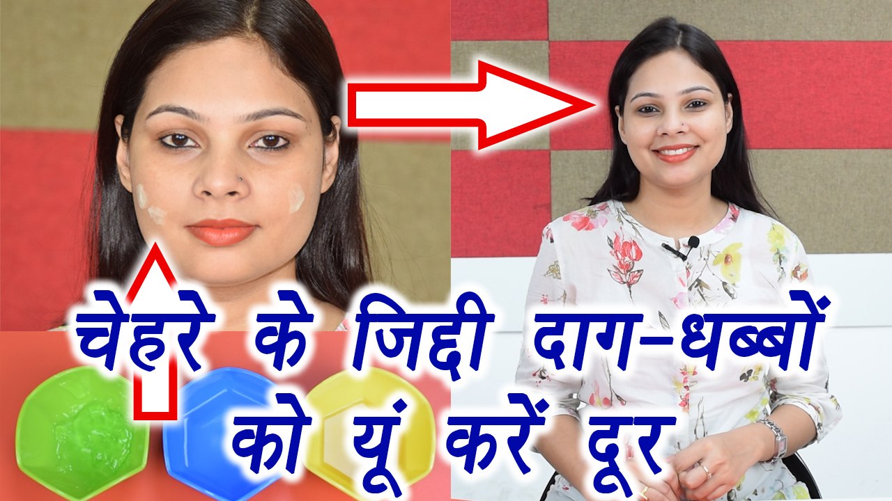 Apple cider vinegar for Pimple Marks मुंहासे के दाग का कारगार उपचार