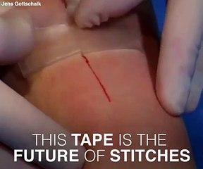 "Khâu" các vết thương lớn chẳng cần mũi kim nào!