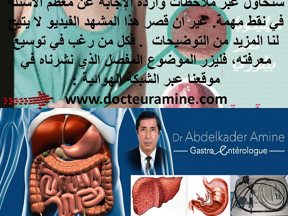 Eradications difficiles de Hélicobacter pylori الحالات العسيرة  لانقراض  جرثومة هيليكوباكتير بيلوري