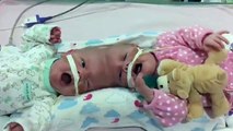 11 days before the conjoind delaney twins undergo first surgery