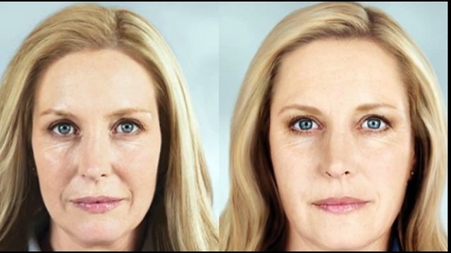 giá tiền căng da mặt bằng chỉ vàng - TS.BS. Mai Mạnh Tuấn