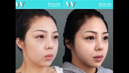 giúp căng da mặt - TS.BS. Mai Mạnh Tuấn