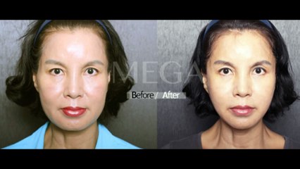 căng da mặt bằng chỉ là gì - TS.BS. Mai Mạnh Tuấn