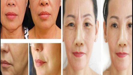 căng da mặt giấu sẹo - TS.BS. Mai Mạnh Tuấn
