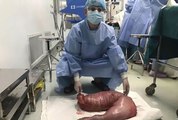 Jovem faz cirurgia para retirar 13 kg de fezes do intestino