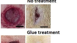 30.Wound-healing glue could prevent scars
