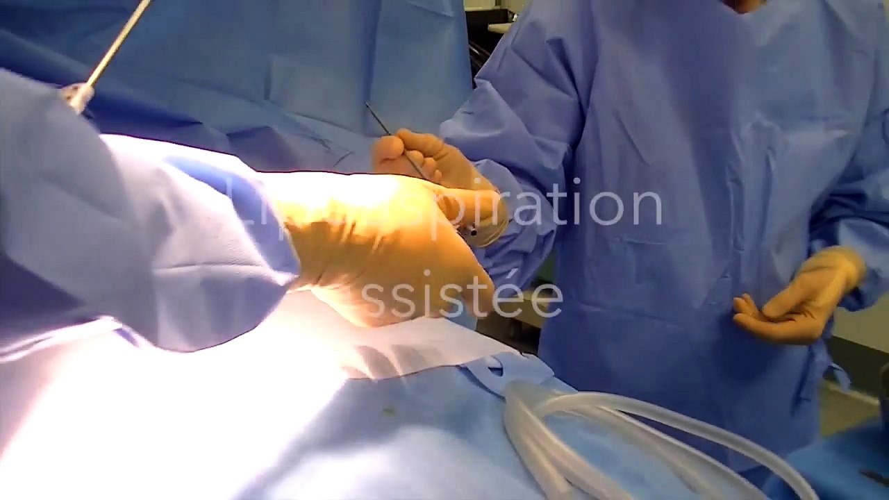 liposuccion Tunisie - affinement silhouette et suppression des graisses