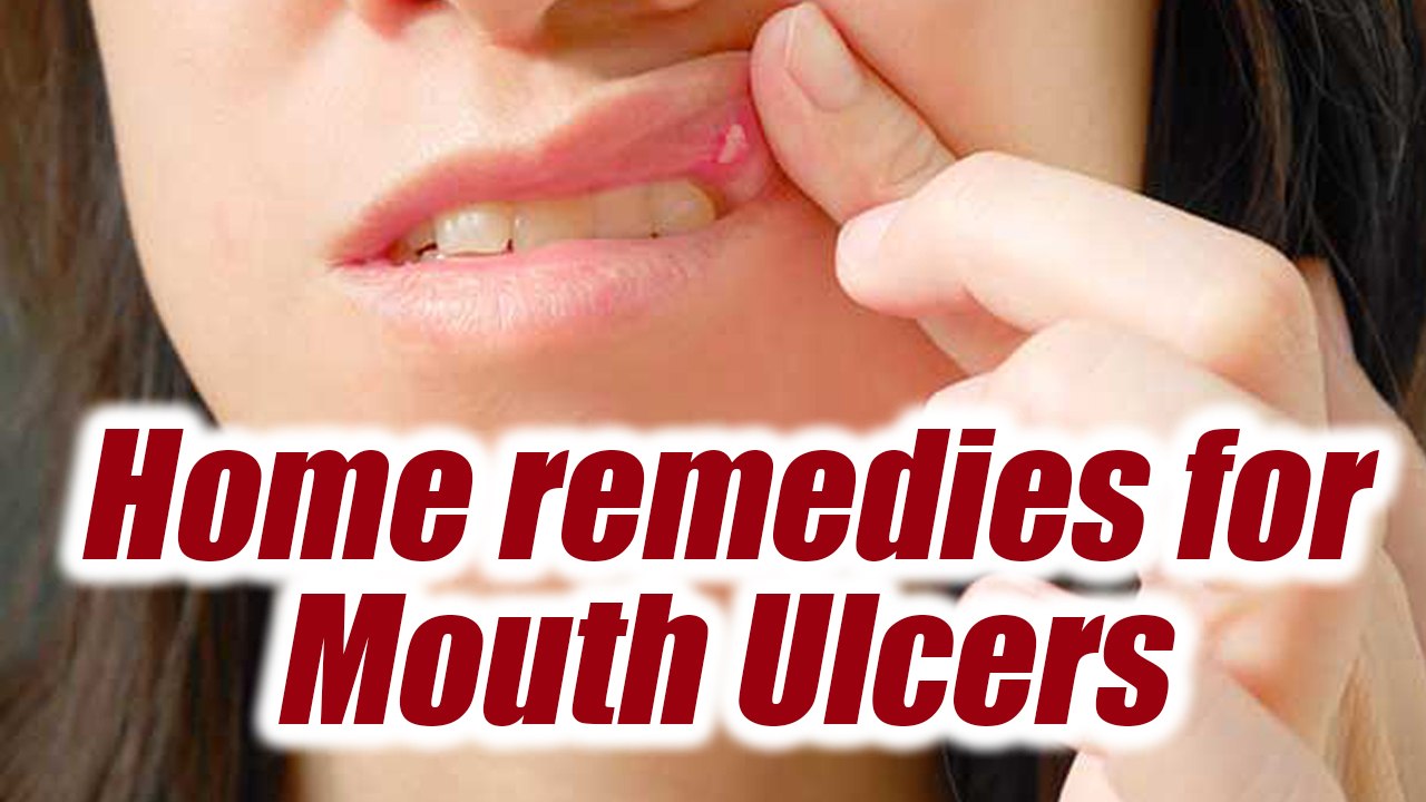 Mouth Ulcer, Home Remedies to treat them; Check out here