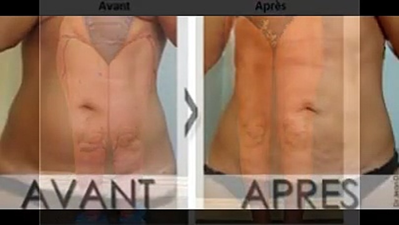 liposuccion-pas-chere-en-tunisie-resultats-garantis-et-photos-avant-apres