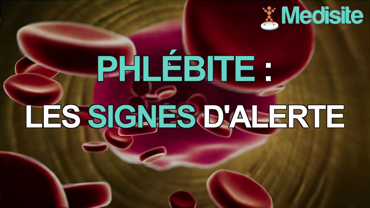 Phlébite : les signes qui doivent vous alerter ! - Vidéo Dailymotion