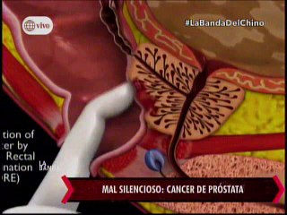 Nota - Mal silencioso Cancer de prostata