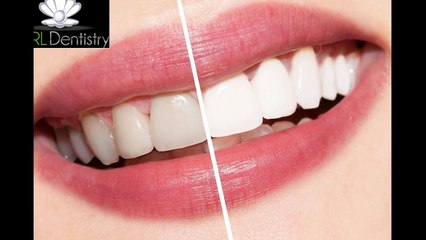 San Antonio Affordable Teeth Whitening
