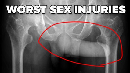 These Are The Worst Sex Injuries You Can Imagine