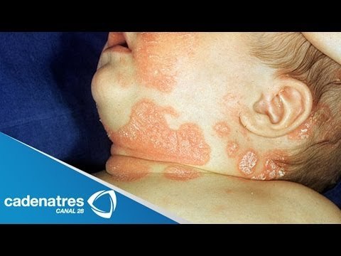 ¿Qué son las enfermedades autoinmunes?