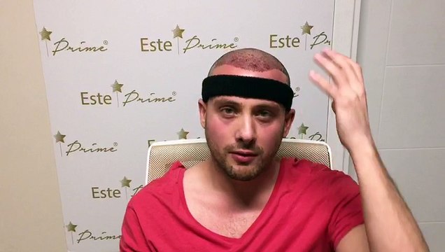 TURKEY HAİR TRANSPLANT -SAÇ EKİMİ