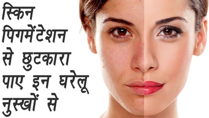 Download Video: Skin Pigmentation: 10 Must-Try Natural Remedies, पिगमेंटेशन से छुटकारा पाए घरेलू नुस्खों से | Boldsky