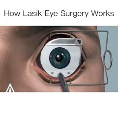 How Lasik Eye Surgery Works
