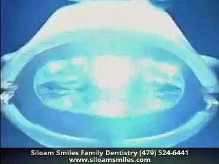 Zoom Whitening Siloam Springs AR