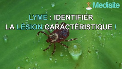 Lyme : identifier la lésion caractéristique !