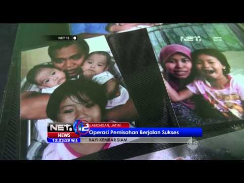 Kondisi Bayi Kembar Siam Sehat dan Normal - NET12