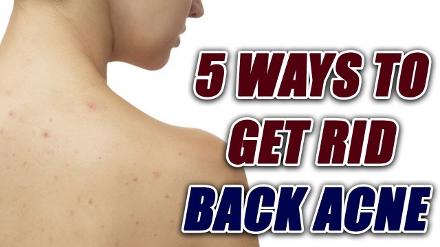 Home remedies to remove back acne; Check out here | Boldsky