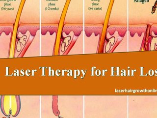 Laser Therapy for Hair Loss