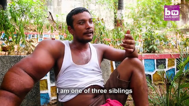 Atteint de Gigantisme son bras pèse 20kg