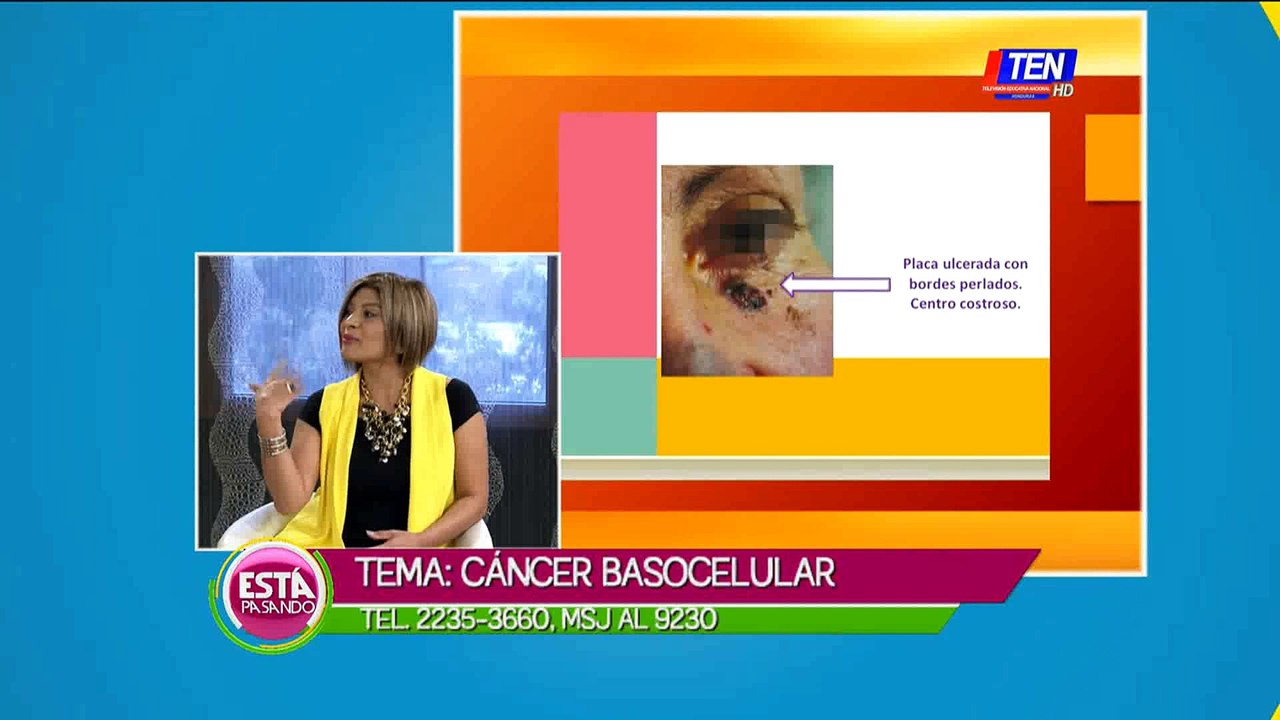 ¿Cómo prevenir el cáncer basocelular?
