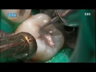 다큐 오늘 - 아말감의 비밀