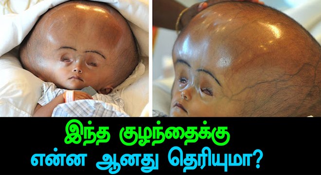 'Giant Head' Baby Roona Begum passed away-Oneindia Tamil
