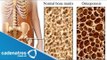 ¿Qué es la Osteoporosis? / Cómo prevenir la osteoporosis